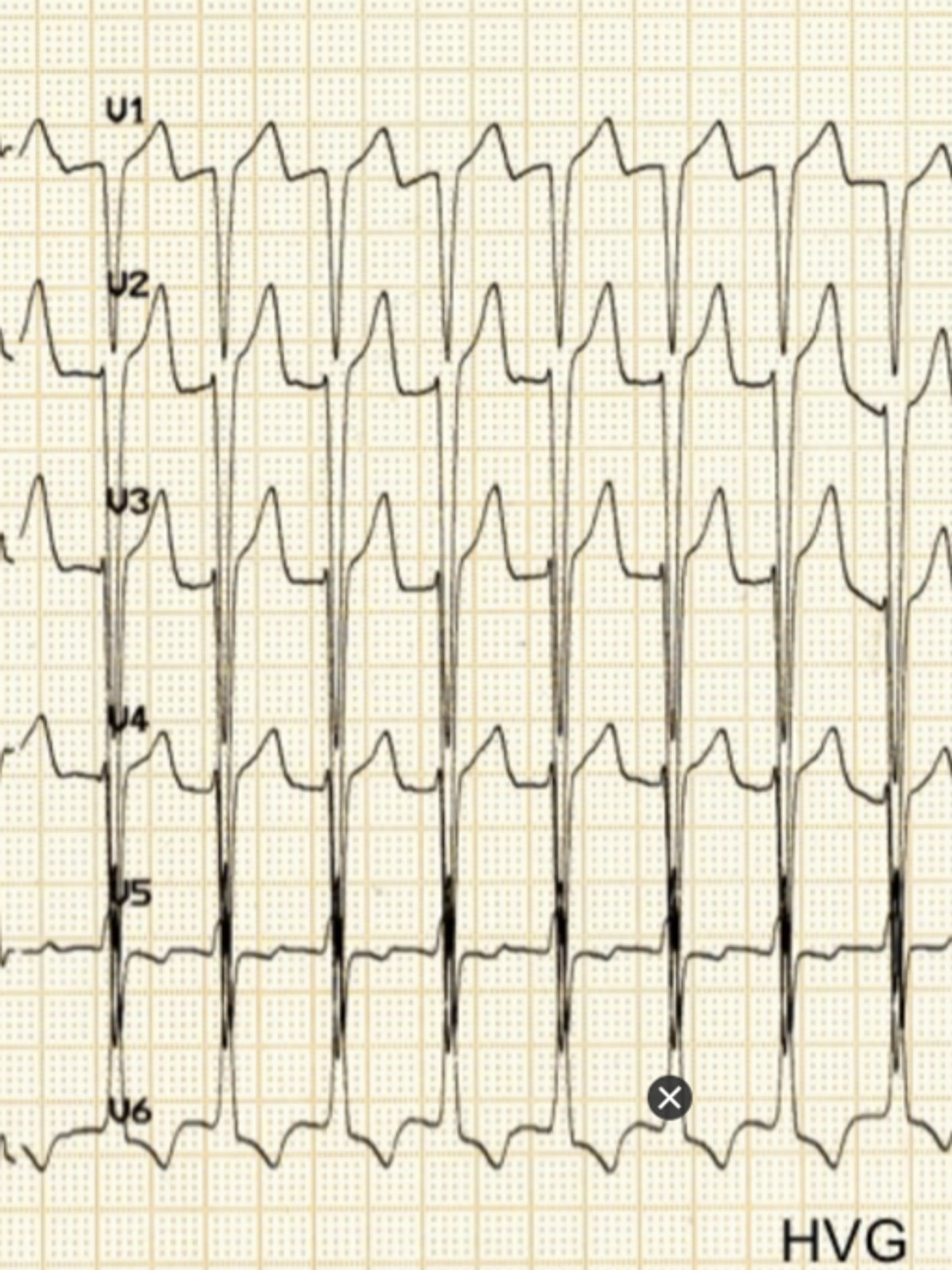 Image de présentation pour l'offre Lecture ECG 2 : module intermédiaire (méthodologie de lecture, axe cardiaque, troubles du rythme et troubles de la conduction) par Jérémy